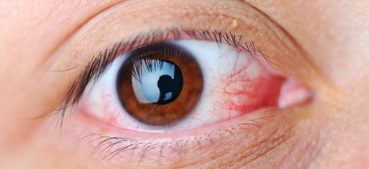 Diabetes Ocular